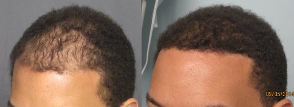 how to regrow black hairline